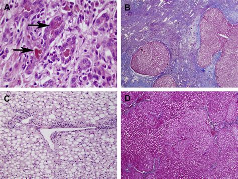 Histology Of Normal Liver Fibrosis And Cirrhosis A Representative Images