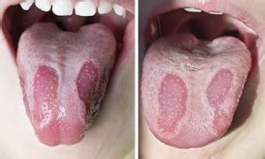 Geographic Tongue Treatment Moses Lake Rory Knapp Dds