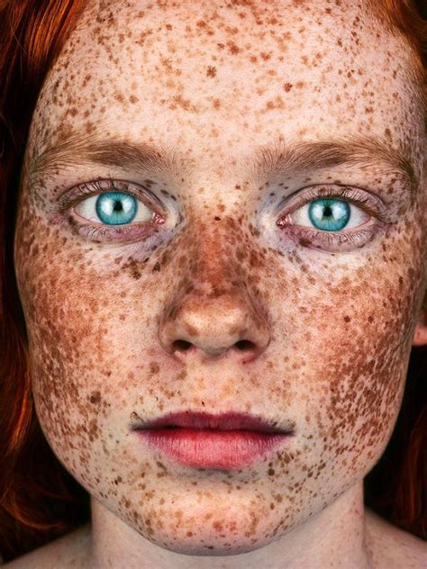 Freckled Beautiful Freckles Freckles Freckles Girl