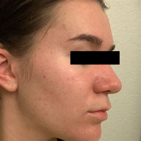 Before And After Tret 0 05 Routine And Explanation In Captions R Tretinoin