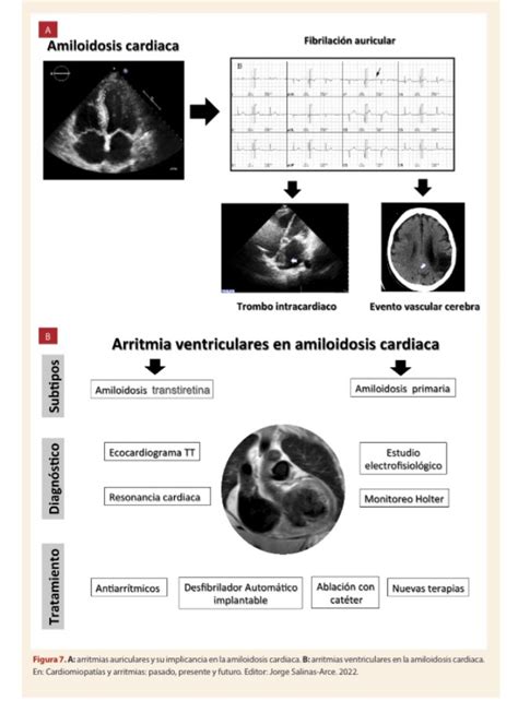 Archivos Peruanos Cardiolog A Y Cirug A Cardiovasc On Twitter