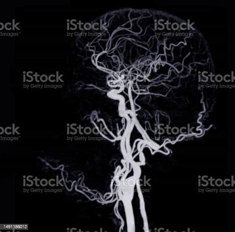 Ct Angiography Of The Brain Or Cta Brain Showing Cerebral Aryery Stock