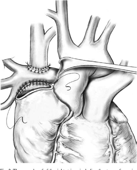 Figure From A New Approach To Hemi Fontan Type Of Operation