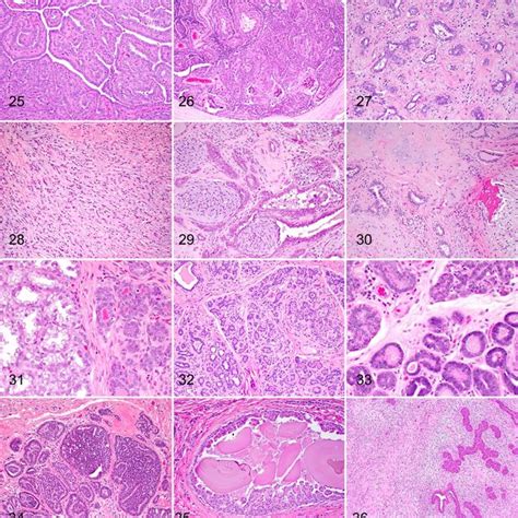 Carcinoma And Malignant Myoepithelioma Mammary Gland Canine Both The