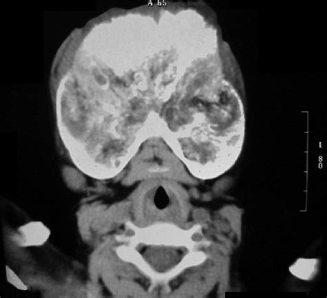 Axial Computed Tomography Scan View Shows A Large Expansile Download Scientific Diagram