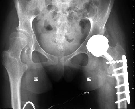 Hip Resurfacing With Femoral Osteotomy For Painful Subluxed Or