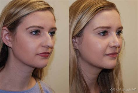 Eric M Joseph Md Rhinoplasty Before After Dorsal Hump Removal