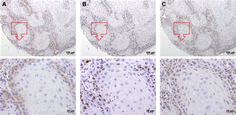 Representative Examples Of Asct2 Ki67 And Gls Staining In The Same