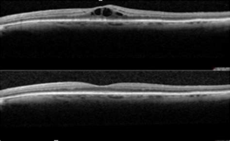 Figure Oct Of The Right Macula That Showed Cmo As A Post Operative