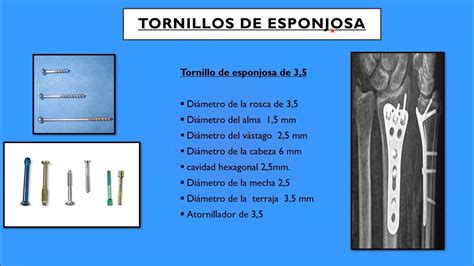 Reconoce Los Tornillos De La OsteosÍntesis Tornillos De Esponjosa Y