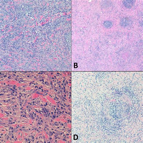 Histopathological Features Of IgG 4 Related Disease A Storiform