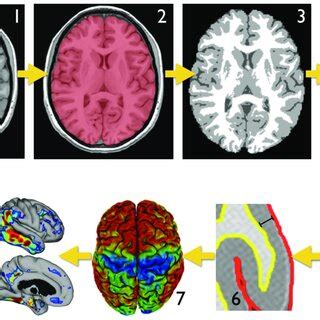 MRI processing steps in determining cerebral cortical thickness. 1. T1 ...