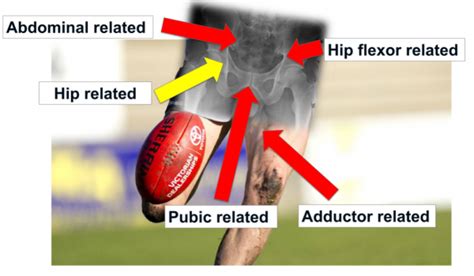 Differential Diagnosis Of Hip Pain — Physio Network