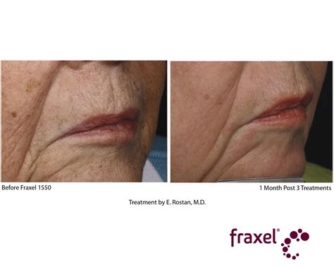 Fraxel Laser Treatment Cost Results Studiomd Midtown Manhattan Nyc