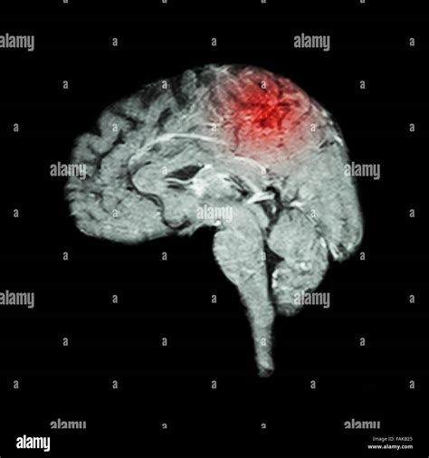 Brain Hi Res Stock Photography And Images Alamy