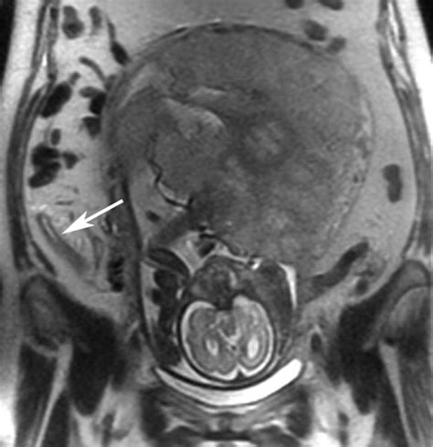 Mri Evaluation Of Acute Appendicitis In Pregnancy Dewhurst 2013