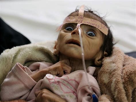 Yemen The Worst Humanitarian Crisis Un Seeker S Thoughts