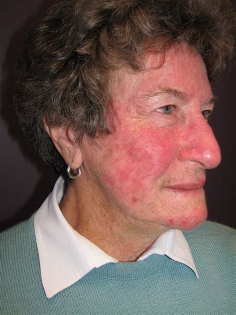 Figure Rosacea Face Dermnet Nw Zealand Statpearls Ncbi Bookshelf