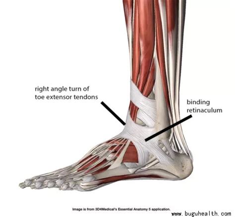 布骨医学科普：足背伸肌支持带与鞋带叮咬症布骨医疗