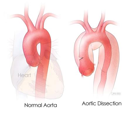 What Is Aortic Disease Mcgovern Medical School