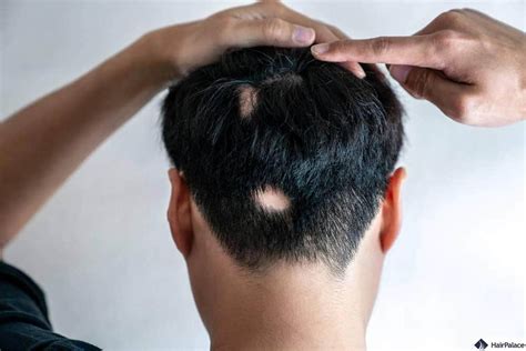 Alopecia Areata: Causes, Symptoms & Best Treatments in 2024