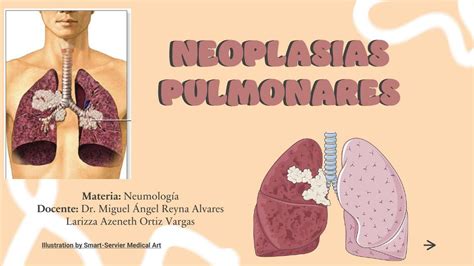 Neoplasias Pulmonares Larizza Azeneth Ortiz Vargas Udocz