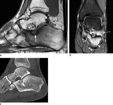 Sinus Tarsi And Sinus Tarsi Syndrome An Imaging Review European