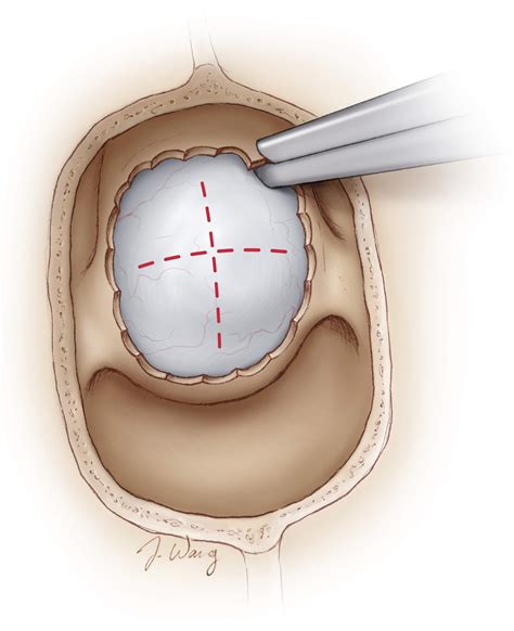 Microscope Guided Endonasal Transsphenoidal Approach The