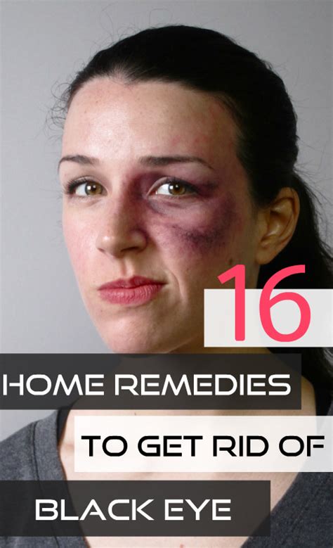 Home Remedy Hacks • 16 Easy Home Remedies To Get Rid Of Black Eye