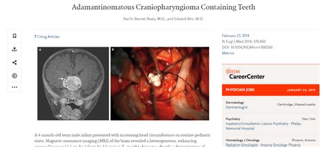 Teratoma Tumor: The demonic mass that grows teeth, eyes, feet, and ...