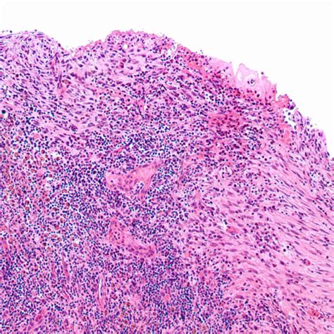 Fibroepithelial Polyp Histology