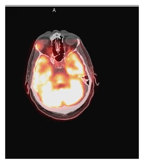 Head Ct Revealing A Lacrimal Gland Mass A Lacrimal Gland Mass On