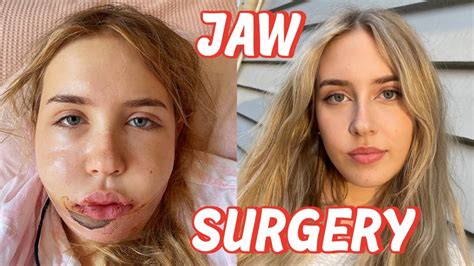 I Had Double Jaw Surgery Vlog And Recovery Youtube