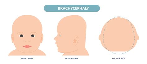 What is plagiocephaly? — Prevent Plagio