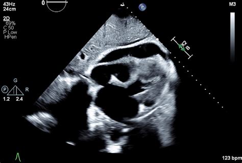 Transthoracic Echocardiogram | Download Scientific Diagram