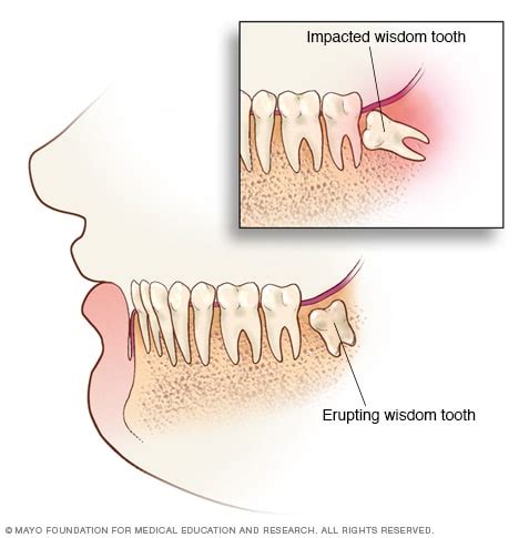 Impacted Wisdom Teeth Symptoms And Causes Mayo Clinic