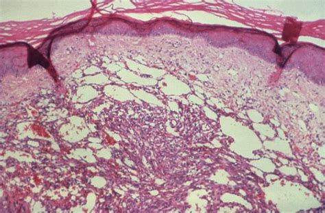 Kaposis Sarcoma Associated Herpes Virus Drives Its Pathogenesis