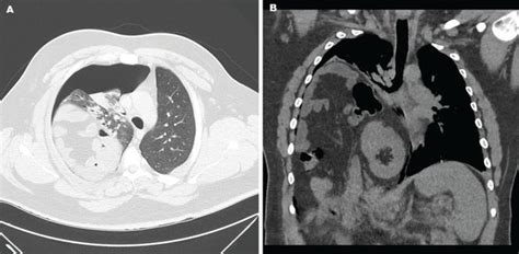 EVENTRASIO DIAFRAGMATIKA (eventration of diaphragm) – radiologi.id