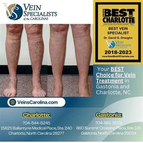 Vein Specialists Of The Carolinas Your Best Choice For Vein Treatment