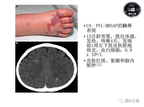 金黄色葡萄球菌肺炎的影像学表现气囊