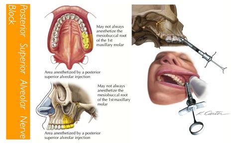 Anestesia Do Nervo Alveolar Superior Posterior Braincp