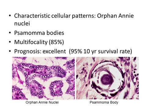 Papillary Thyroid Cancer Orphan Annie Eyes