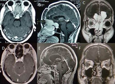 cranial  image displaying olfactory groove tumor  nasal cavity