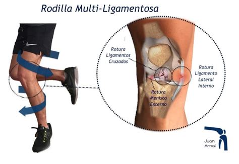 Rodilla Multi Ligamentosa Rotura Varios Ligamentos De La Rodilla