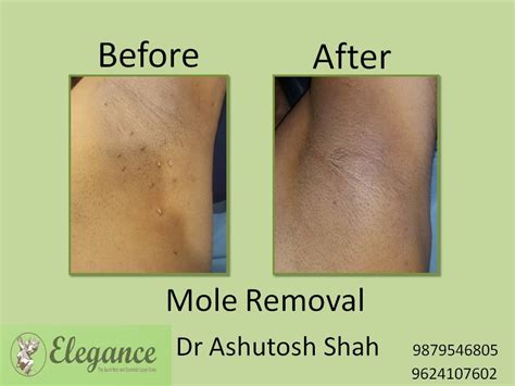 Mole Removal Treatment Kim Gujarat India