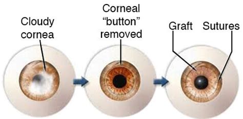 Cornea Transplant | Lee Eye Center