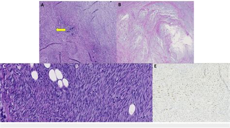 Case 4 Histopathology Findings A Low Power Magnification Of A Spindle