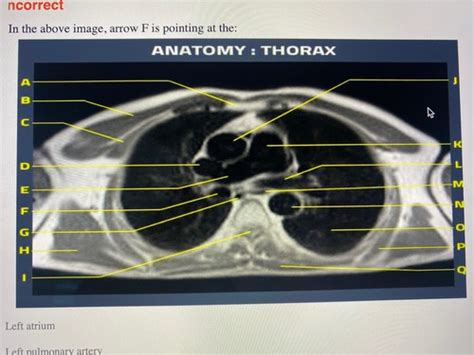 Review Mri Flashcards Quizlet