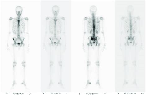 Bone Scintigraphy Tc M Mdp Scan The Scan Shows Heterogeneous