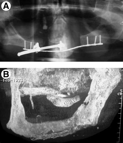 Distraction Osteogenesis In The Irradiated Mandible For Segmental